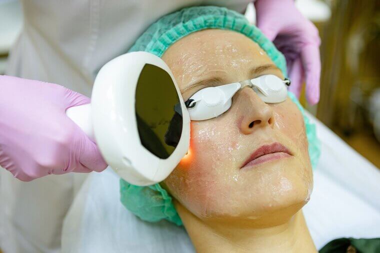 CO2 Laser Resurfacing: Heat-Induced Trauma and Raw Skin Sensitivity