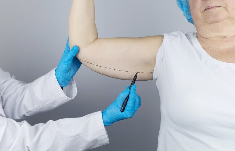 Brachioplasty (Arm Lift): Constant Tension and Restricted Movement