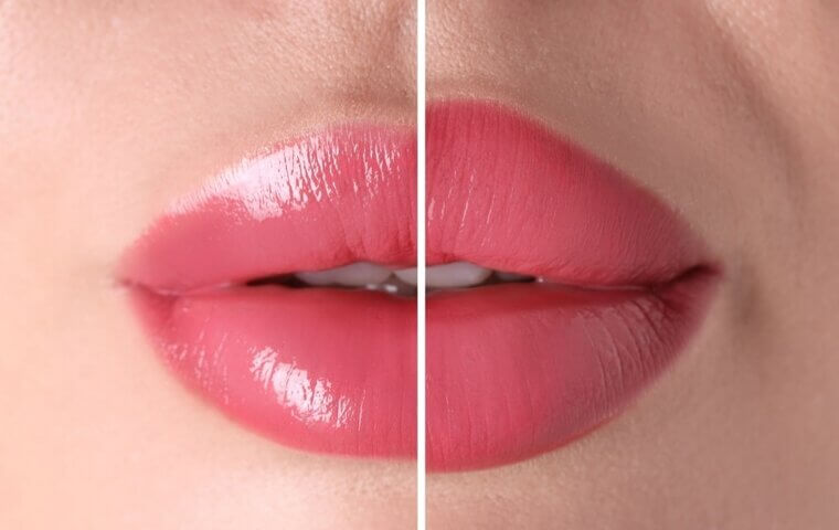 Lip Lift: Tension Under the Nose and Restricted Smiling
