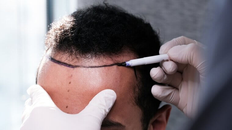 Hair Transplant (FUT Method): Scalp Tension and "tight Hat" Sensation