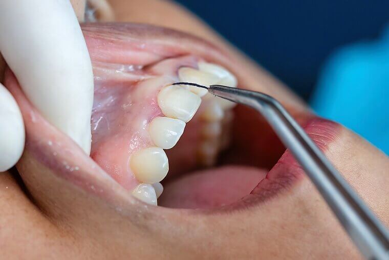 Gum Contouring: Sensitive Nerve Exposure and Oral Irritation