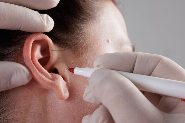 Otoplasty (Ear Pinning): Cartilage Tenderness and Sleeping Difficulties