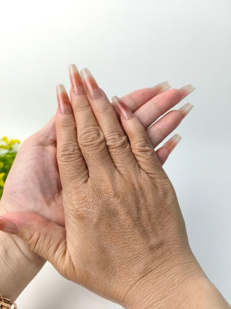 Hand Rejuvenation (Fat Transfer): Swelling and Loss of Dexterity