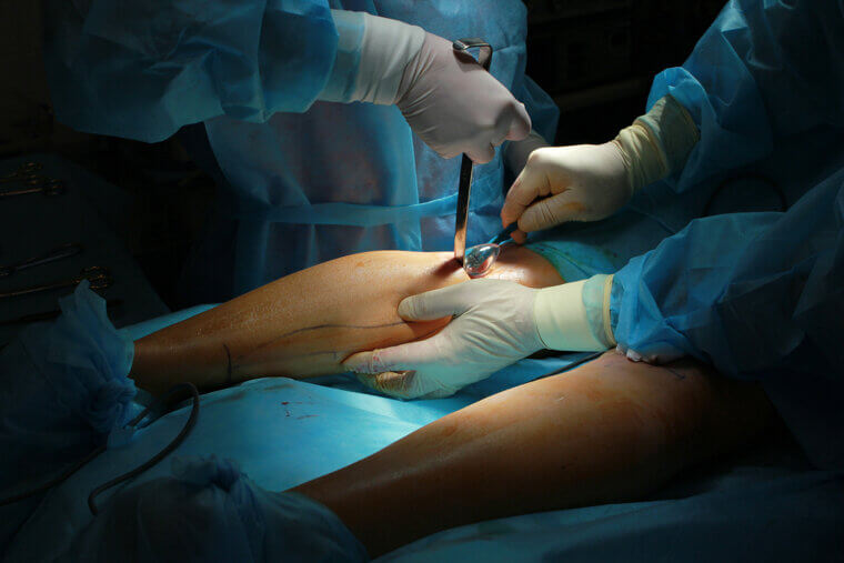 Calf Implants: Muscle Stretching and Walking Difficulties