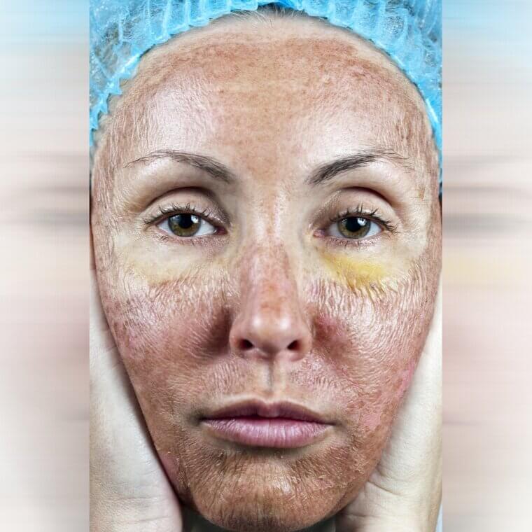 Deep Chemical Peel (TCA): Intense Stinging and "tight Mask" Sensation
