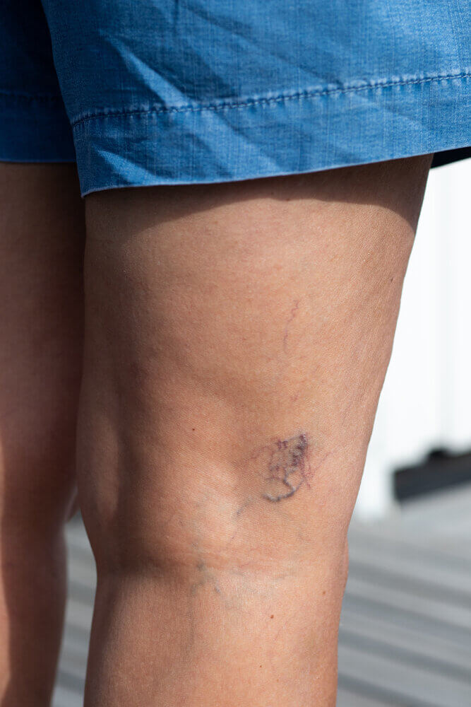 Medial Thigh Lift: Groin Sensitivity and High Infection Risk