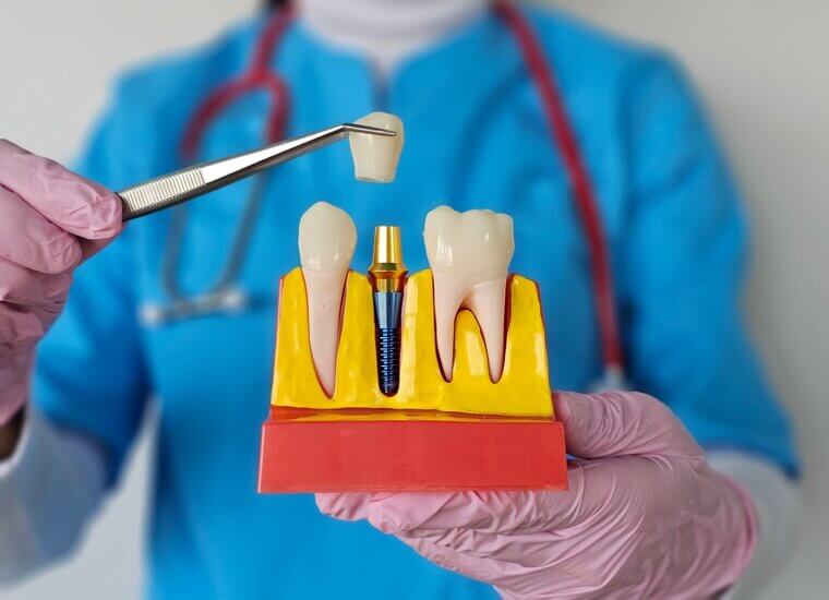 Dental Implants: Jawbone Drilling and Significant Pressure