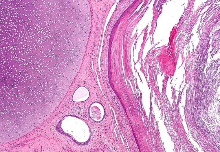 There Is A Specific Type Of Tumor That Grows On Hair And Teeth
