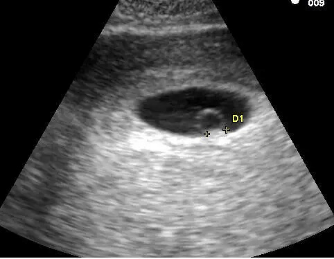 The First Thing That Develops In A Human Embryo Is The Anus