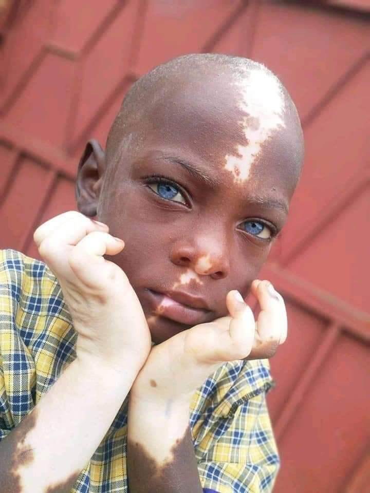 A Young Boy With a Rare Condition