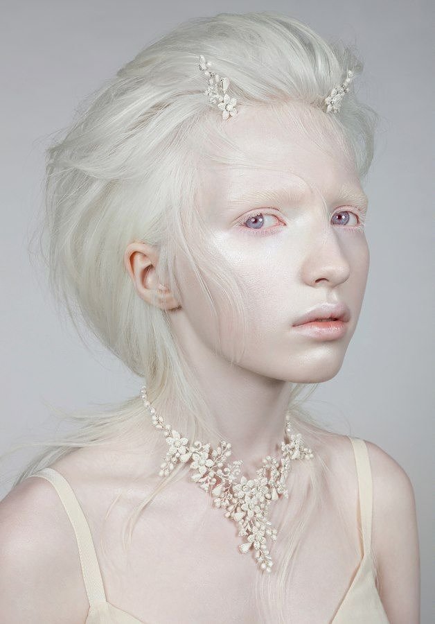 A Model With Albinism