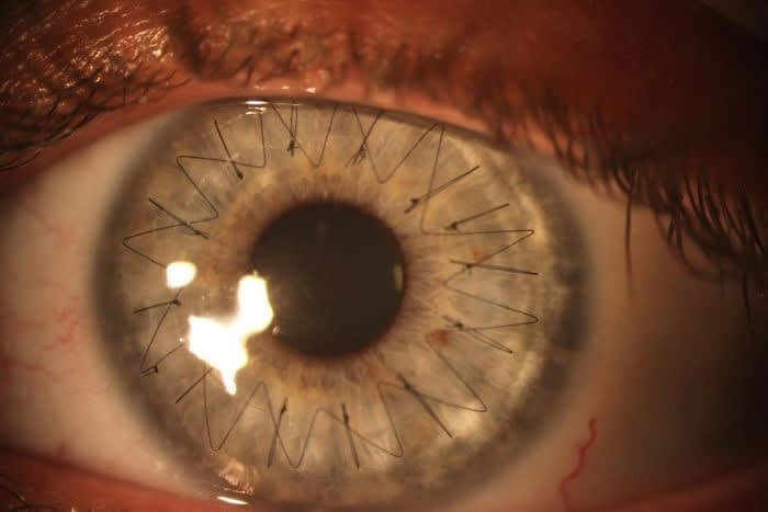 How The Eyeball Looks Like After A Cornea Transplant