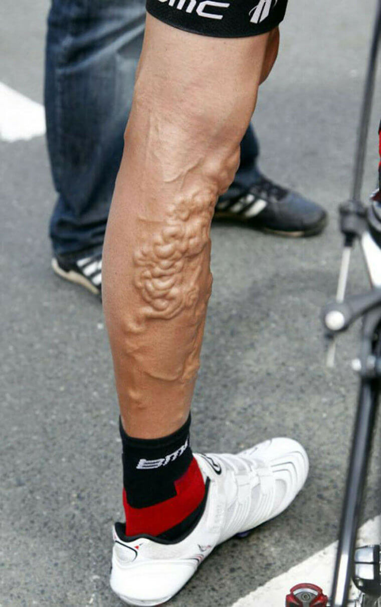 We Apologize in Advance for This Nightmare of a Veiny Leg