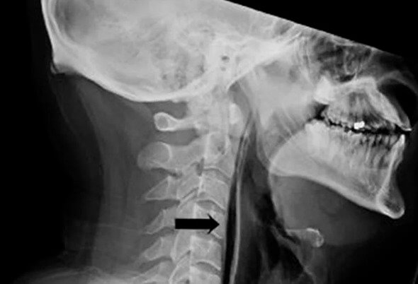Sneezing a Certain Way Can Cause a Hole in Your Throat