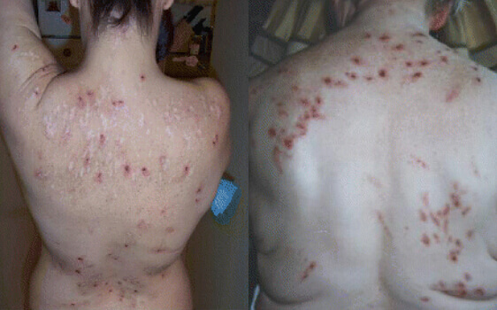 Creepy Crawlies Underneath Your Skin