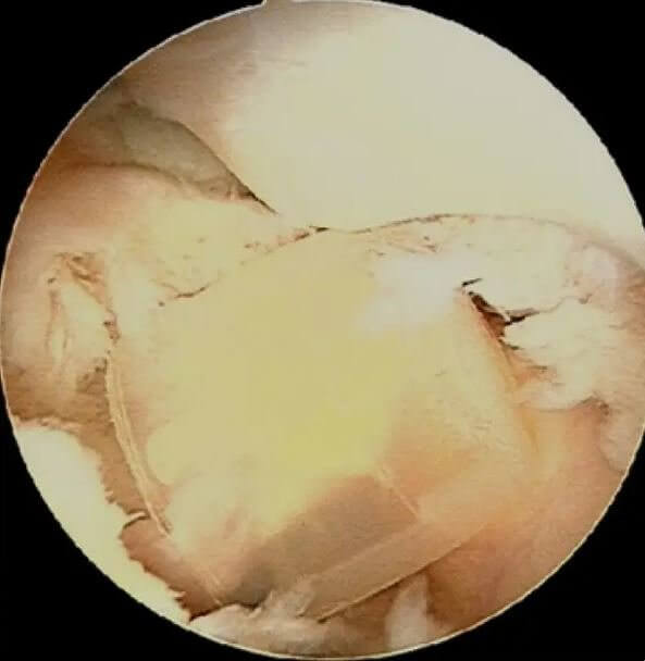 Not What You Expect to Find in a Kneecap