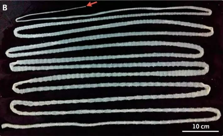 Guess How Long the Tape Worm Inside Him Was