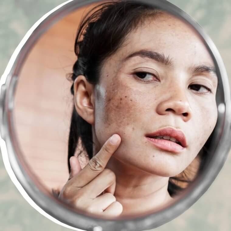 You Could Get Freckles, or Even a 'Pregnancy Mask'