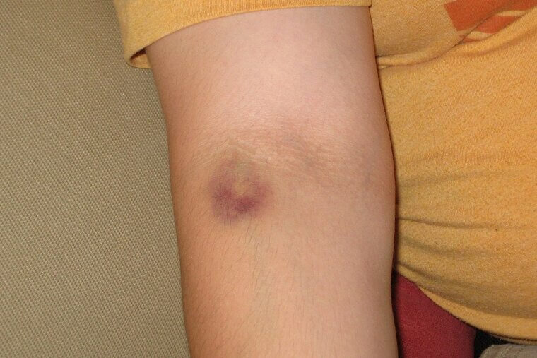 Skin Bruises Easily