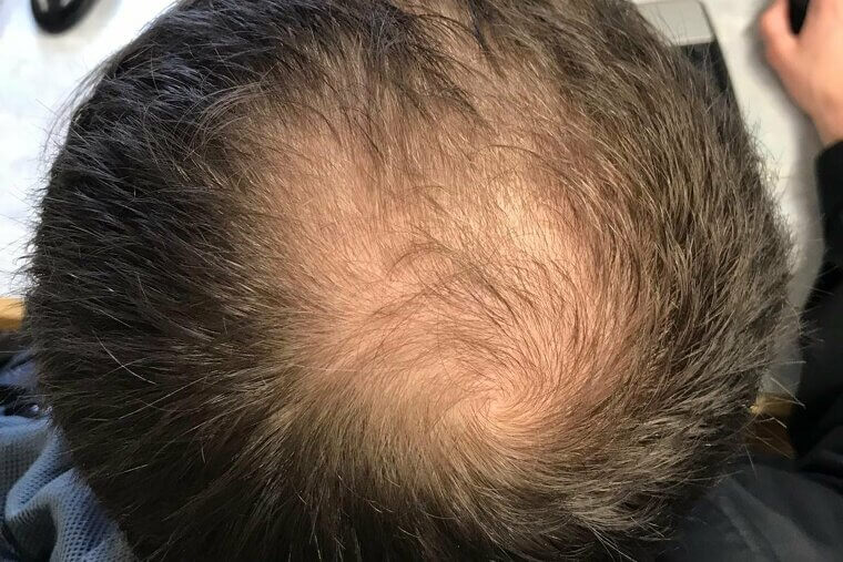 Thinning Hair or Hair Loss