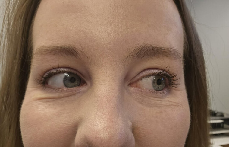 Excessive Wrinkles Around Eyes and Mouth