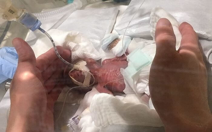 A valaha született legkisebb súlyú életben maradt gyermek egyike