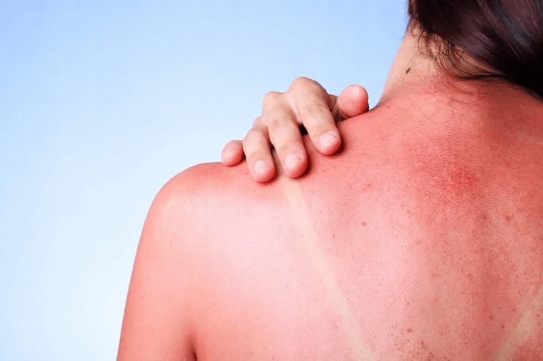 Relieve Your Sunburn