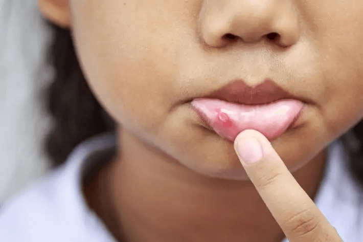 Alleviate Sores