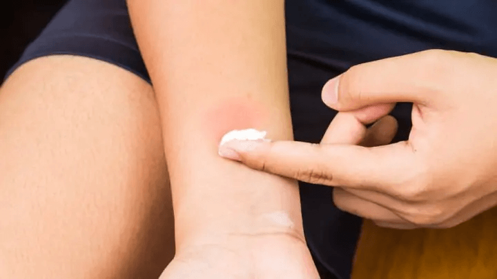 Relieve Yourself From Bug Bites