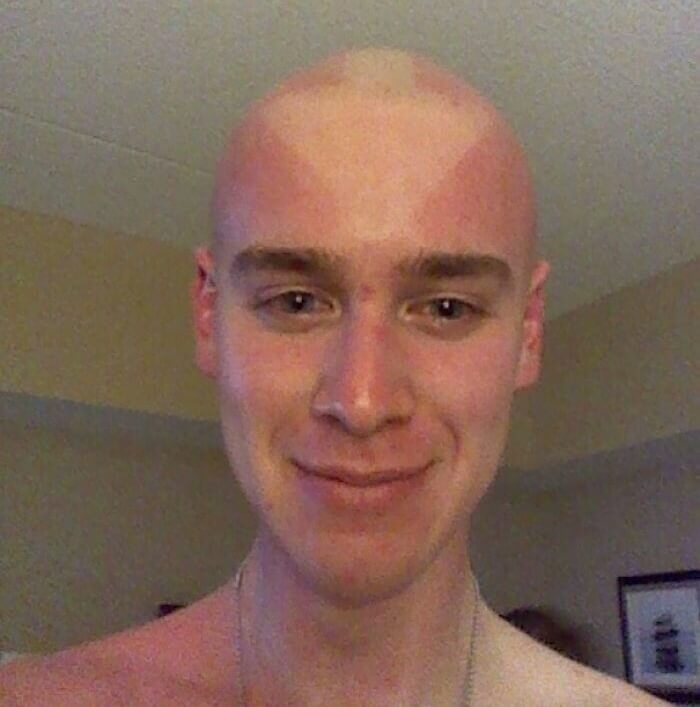 Avatar: The Last Sunburn Bender