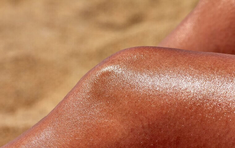 Sunburn Is Just Part of Summer