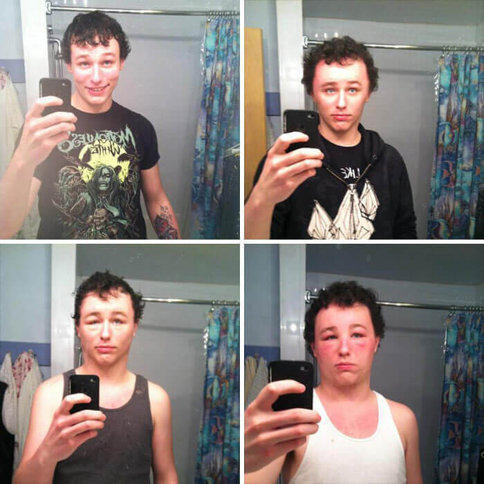 This Guy Had To Take Antihistamines After Dyeing HIs Hair