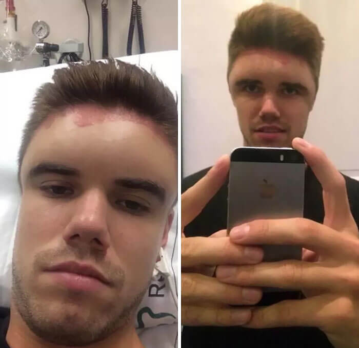 This Guy Found Out That He's Allergic To Hair Dye A Little Too Late