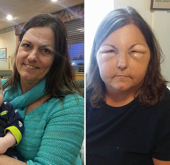 Another Person, Another Allergic Reaction