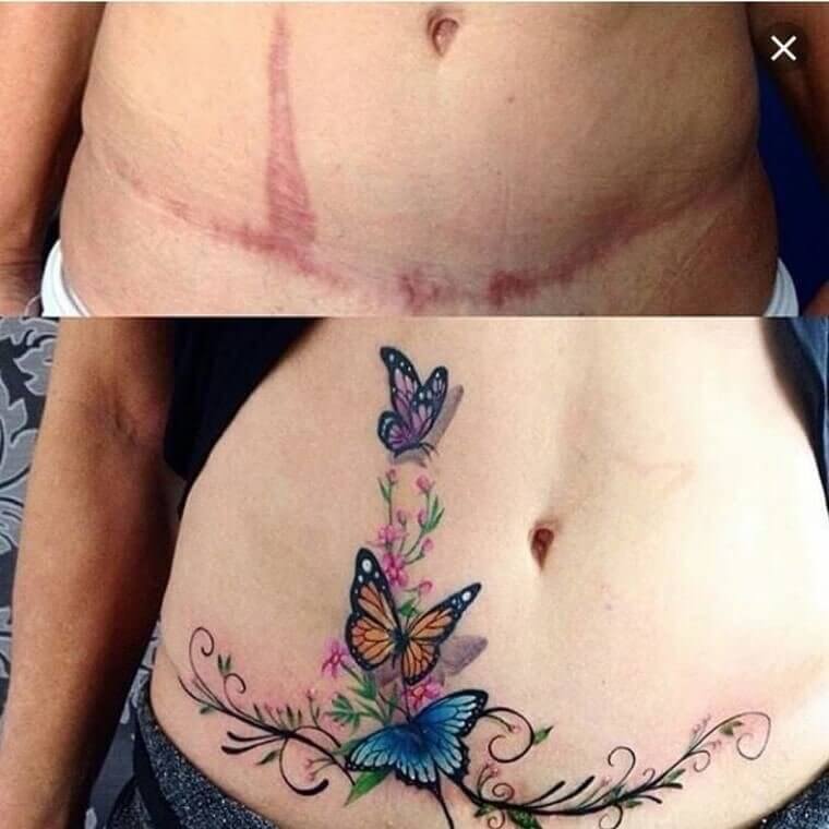 A Beautiful Scar Celebrating Life