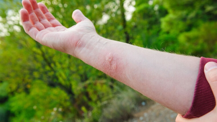 Alleviate Irritating Bites and Stings