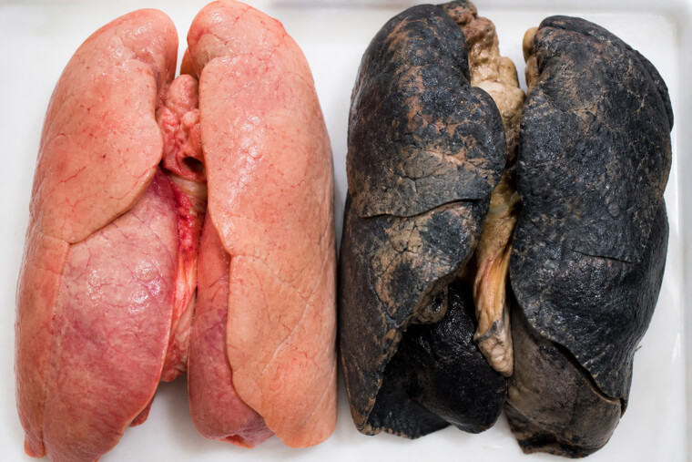 Healthy Lung vs Smoker's Lung Side by Side