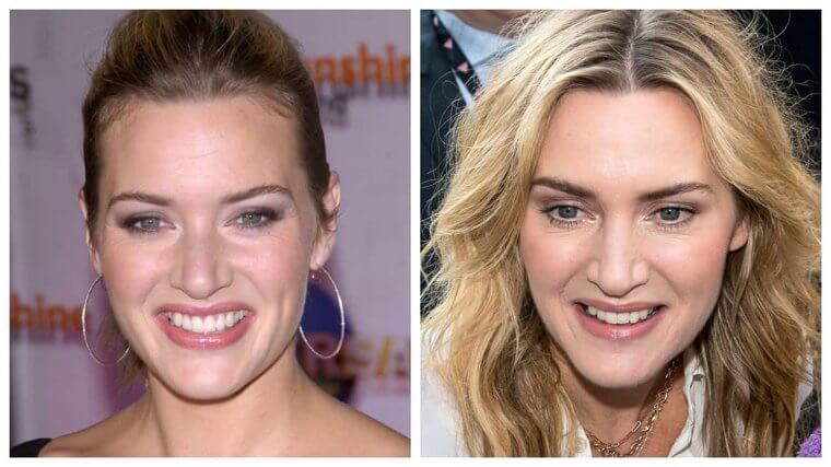 Kate Winslet - 2004 Vs. 2017 (13 Year Difference)