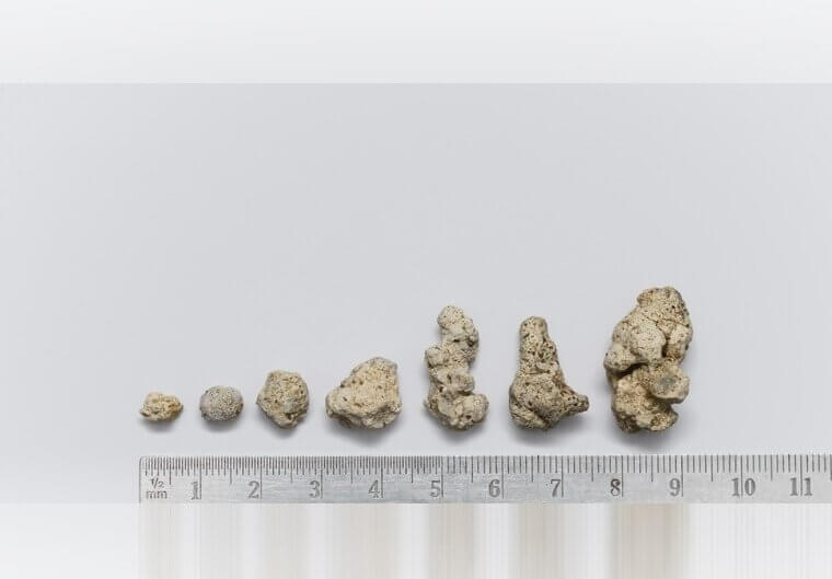 Kidney Stone Removal: The Ureter's Agony