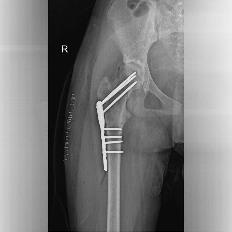 Femur Fracture Repair: Fixing the Largest Bone