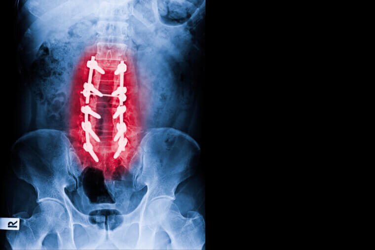 Laminectomy: Pressure and Pain Release