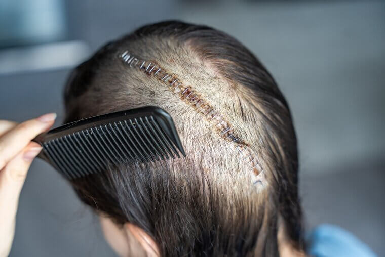 Craniotomy: Head and Neck Discomfort