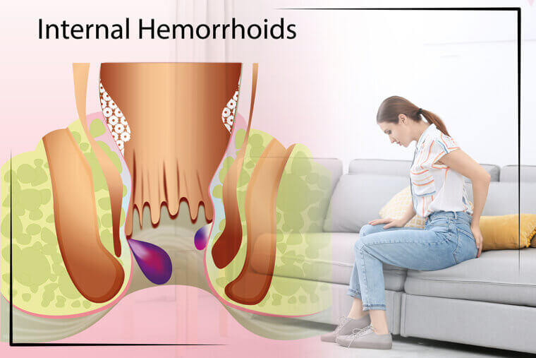 Hemorrhoidectomy: The Unmentionable Ache