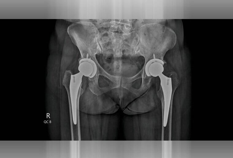 Hip Replacement: A Joint Effort in Pain