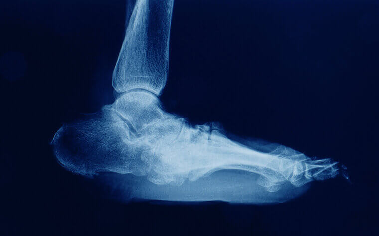Ankle Fusion: The Ground-Level Ache