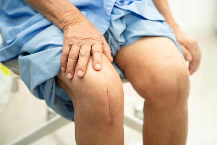 Total Knee Replacement: The Price of Mobility