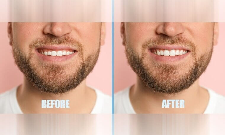 Gingivectomy: The Rawness of the Mouth