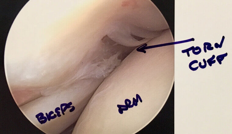 Rotator Cuff Repair: The Shoulder's Struggle