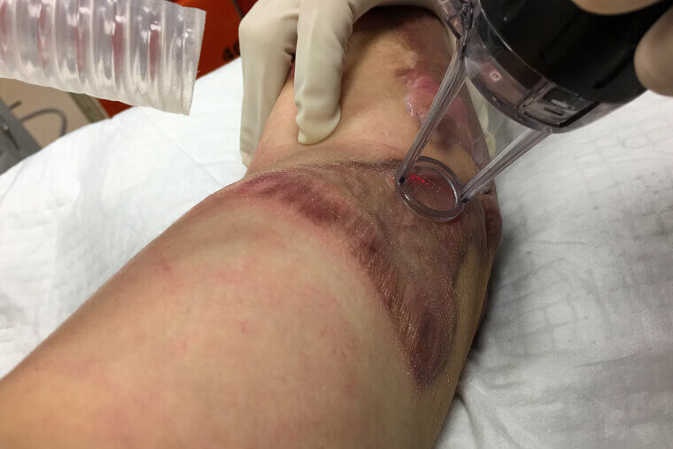 Skin Grafting: The Two-Site Burn