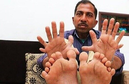 Can You Count How Many Fingers And Toes He Has?